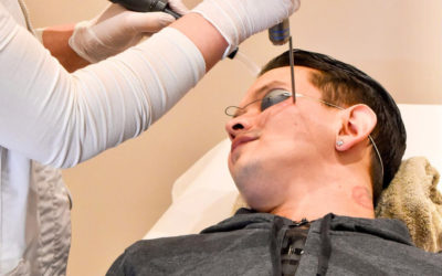 Laser pigmentvlekken gezicht