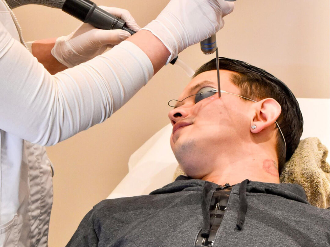 Laser pigmentvlekken gezicht