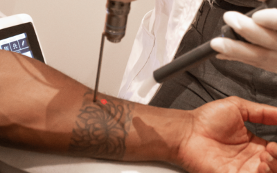 Nazorg tattoo laseren