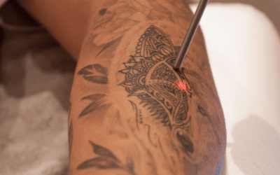 Tattoo laten verwijderen