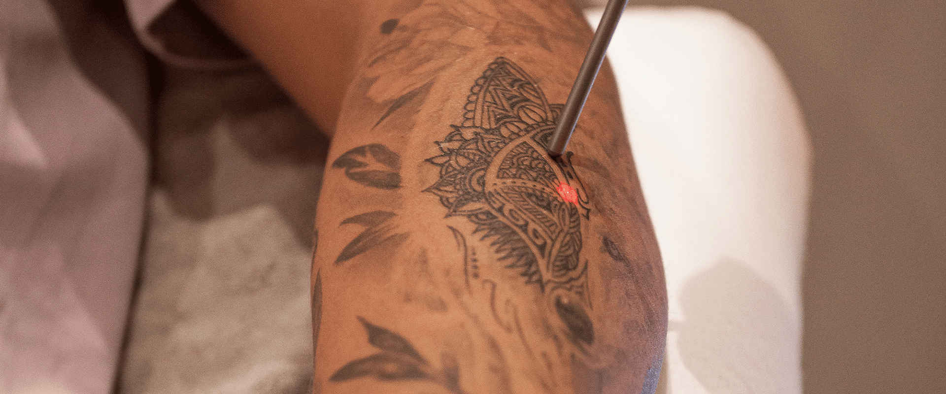 laser tattoo removal 
