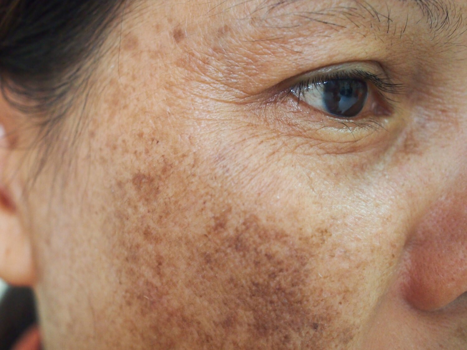 Laserbehandeling ouderdomsvlekken