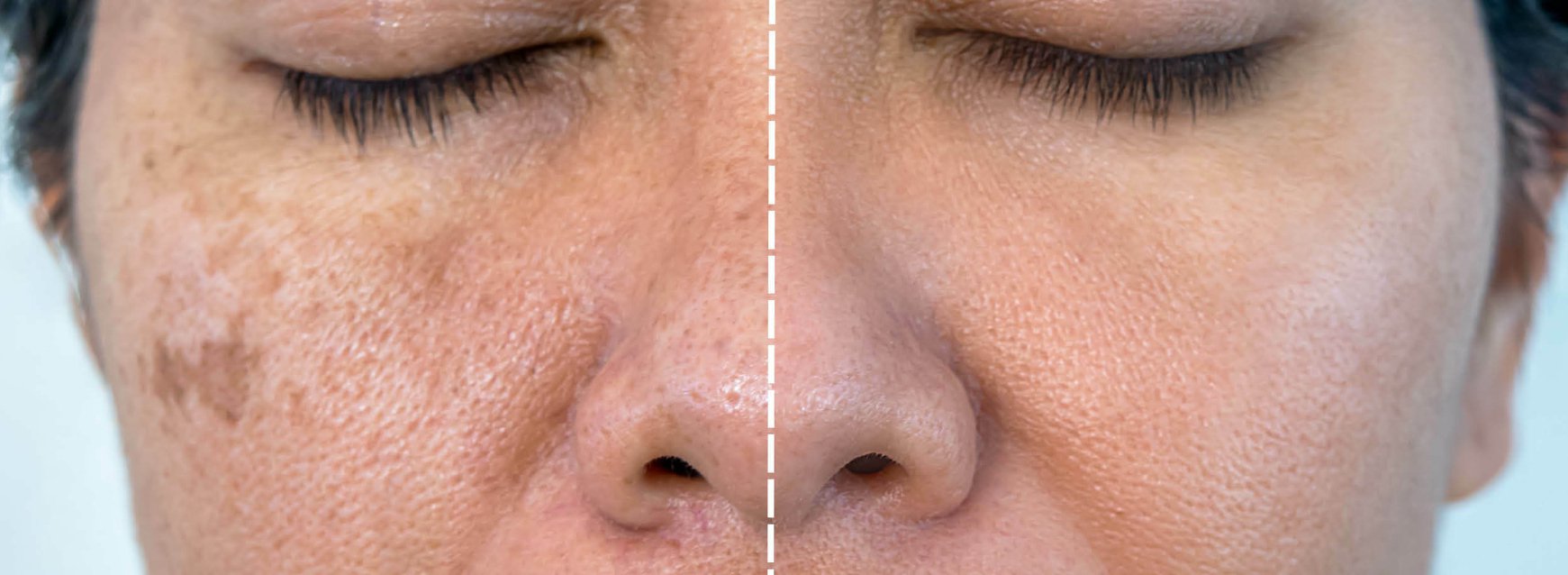 Pigmentvlekken gezicht verwijderen